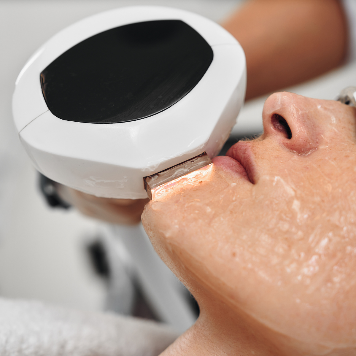 Laser Treatment