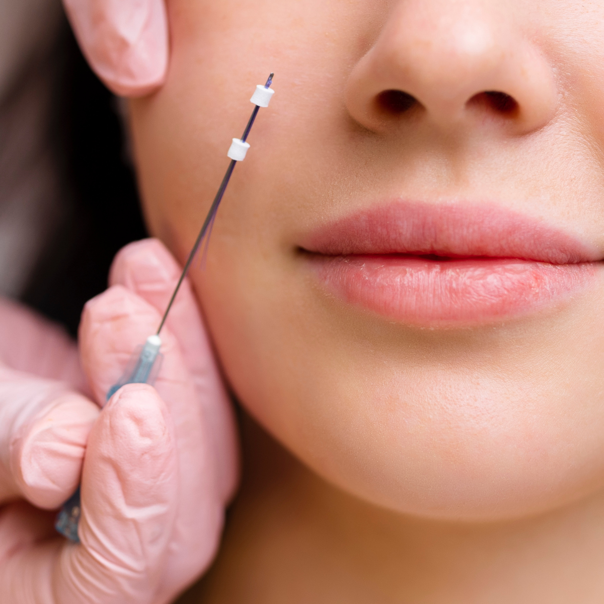 Thread lift