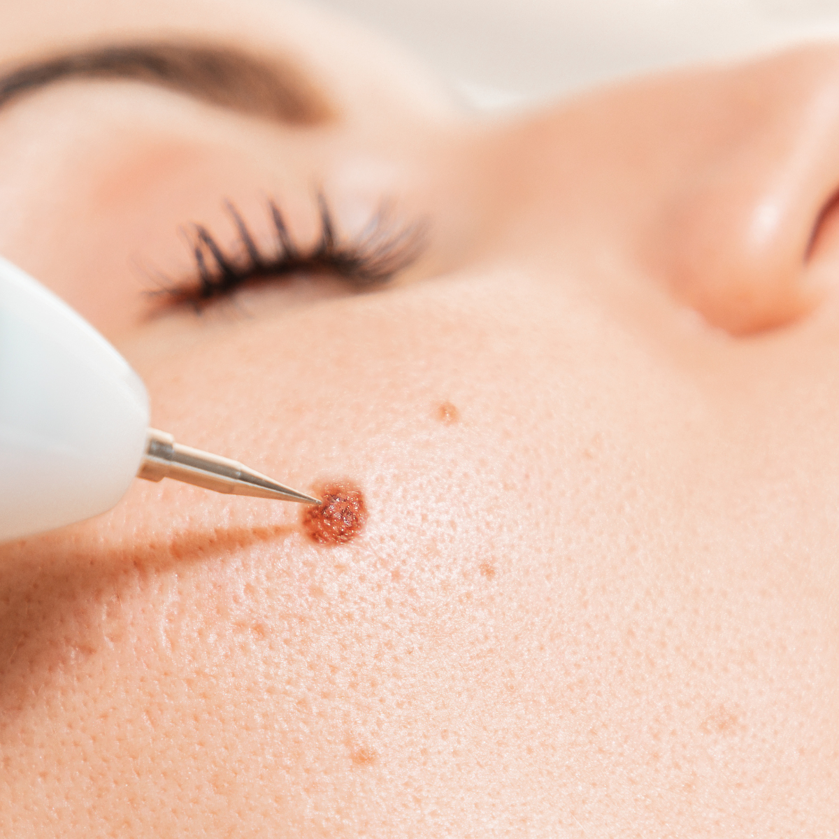 Laser Treatment