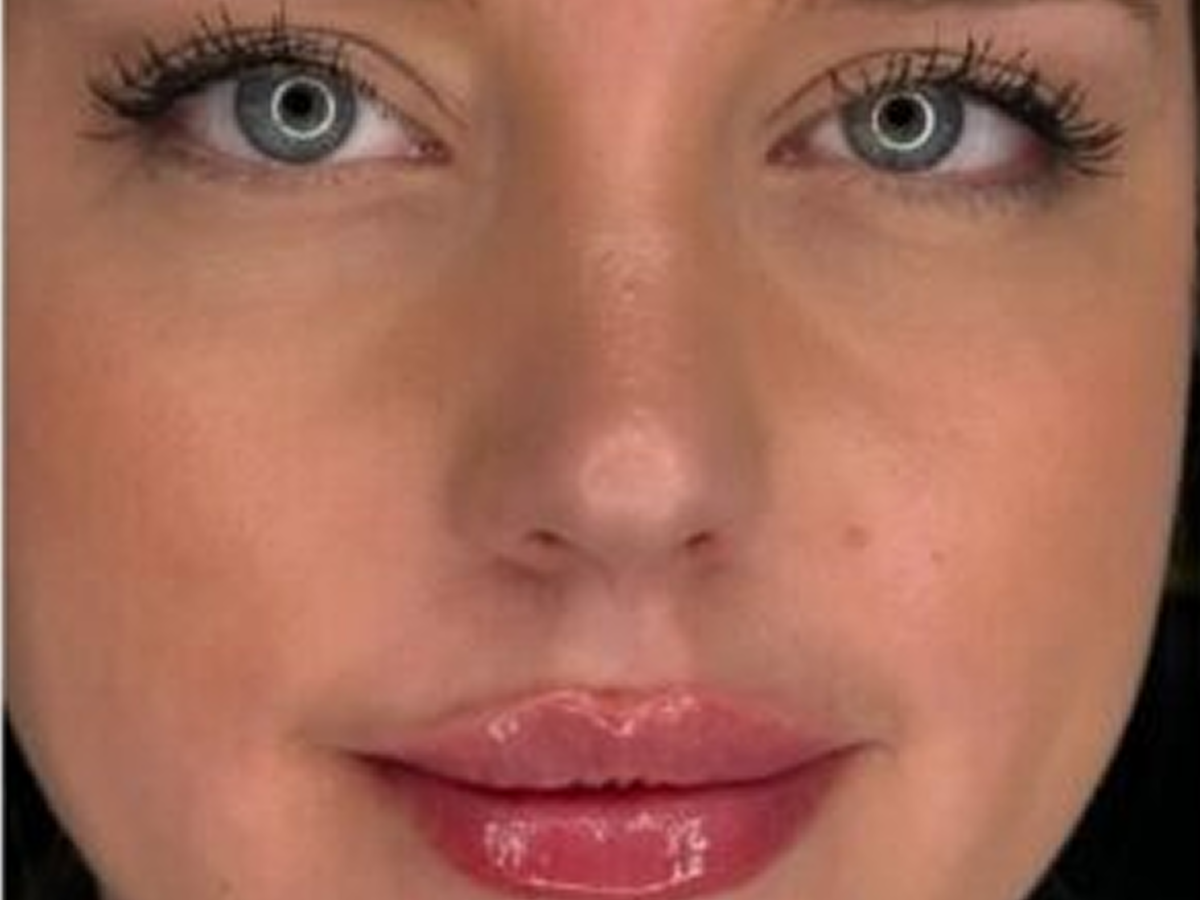 Reducing dark under eye circles