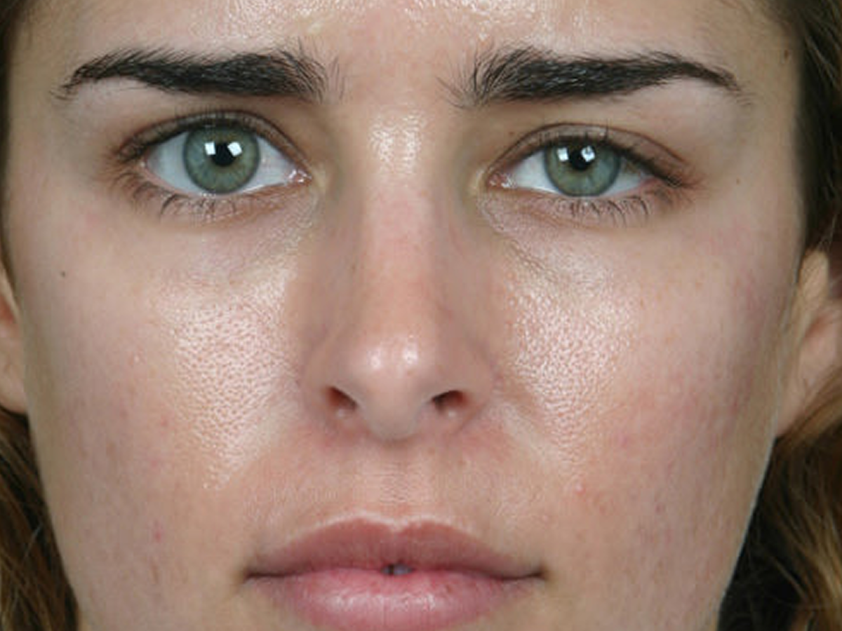 Expert skin texture treatment results