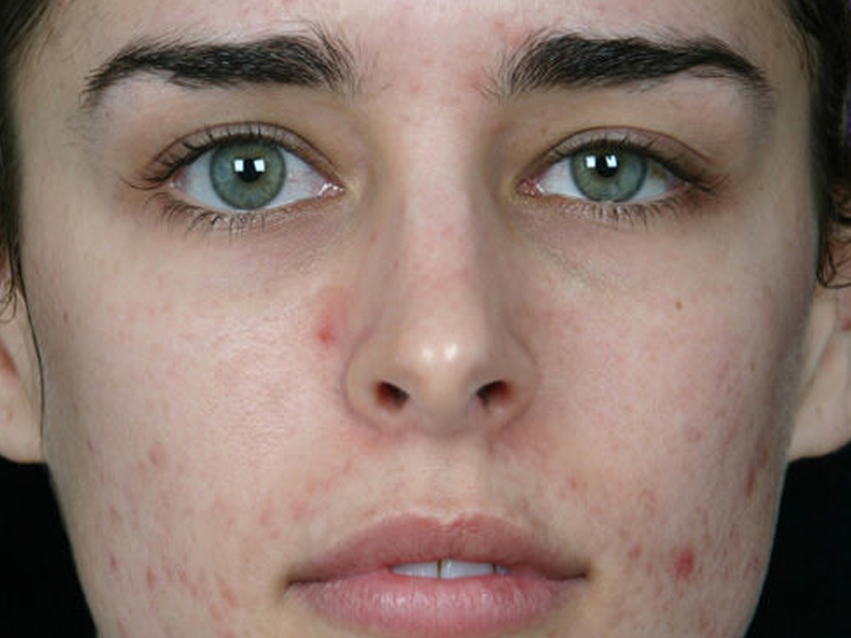 Medical grade facial rejuvenation