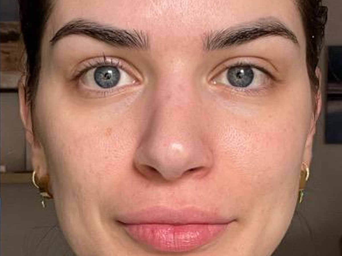 Effective under eye hollows treatment