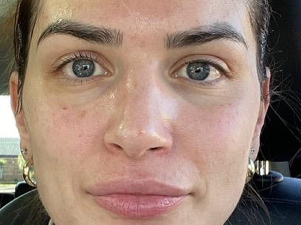 Expert tear trough filler results