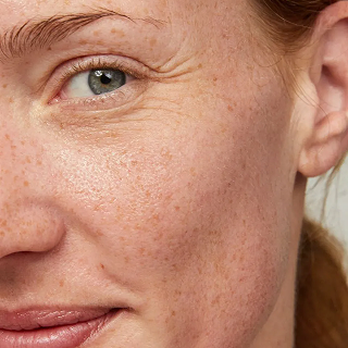 Targeted sun damage pigmentation solution