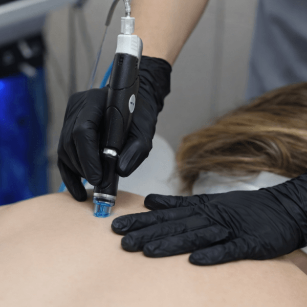 Deep cleansing back Hydrafacial treatment