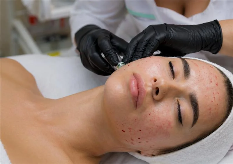 You are currently viewing PRP Treatment vs Microneedling: Which One to Choose & When