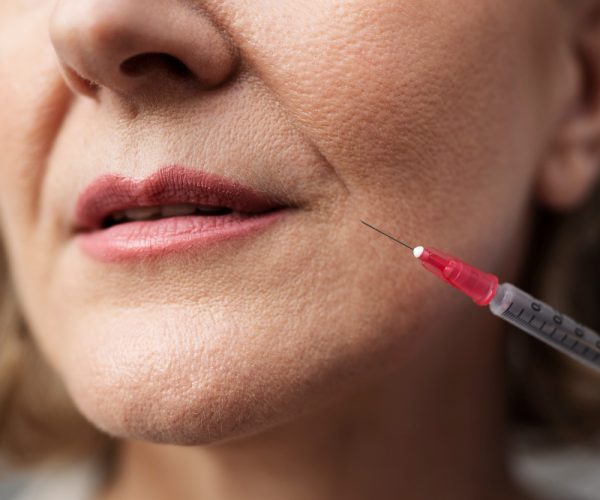 Professional smile line filler treatment